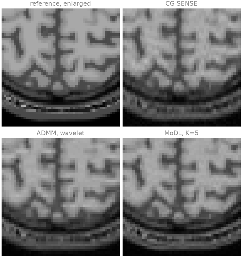reference, enlarged, CG SENSE, ADMM, wavelet, MoDL, K=5