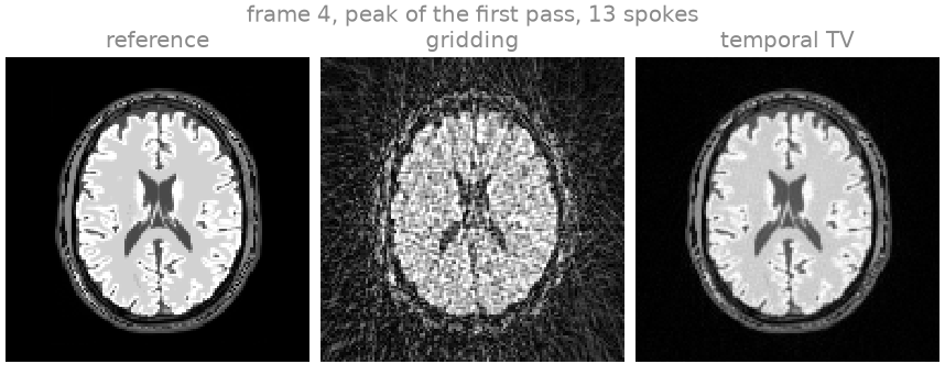 frame 4, peak of the first pass, 13 spokes, reference, gridding, temporal TV