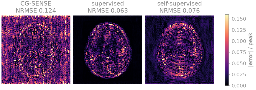 CG-SENSE NRMSE 0.124, supervised NRMSE 0.063, self-supervised NRMSE 0.076