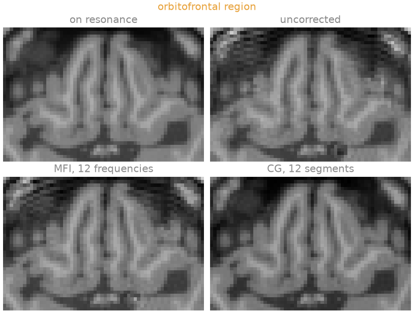orbitofrontal region, on resonance, uncorrected, MFI, 12 frequencies, CG, 12 segments