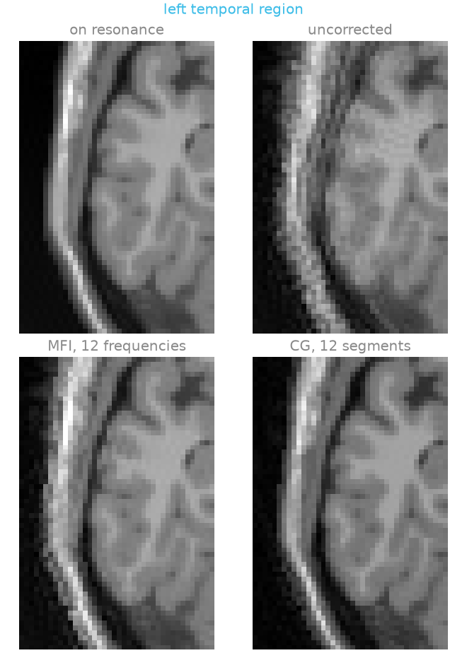 left temporal region, on resonance, uncorrected, MFI, 12 frequencies, CG, 12 segments