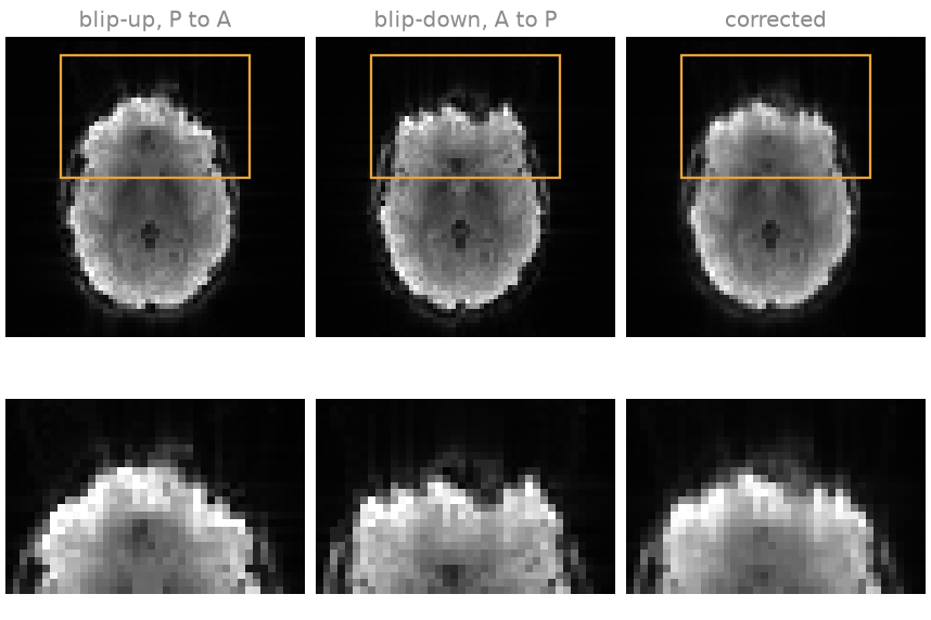 blip-up, P to A, blip-down, A to P, corrected