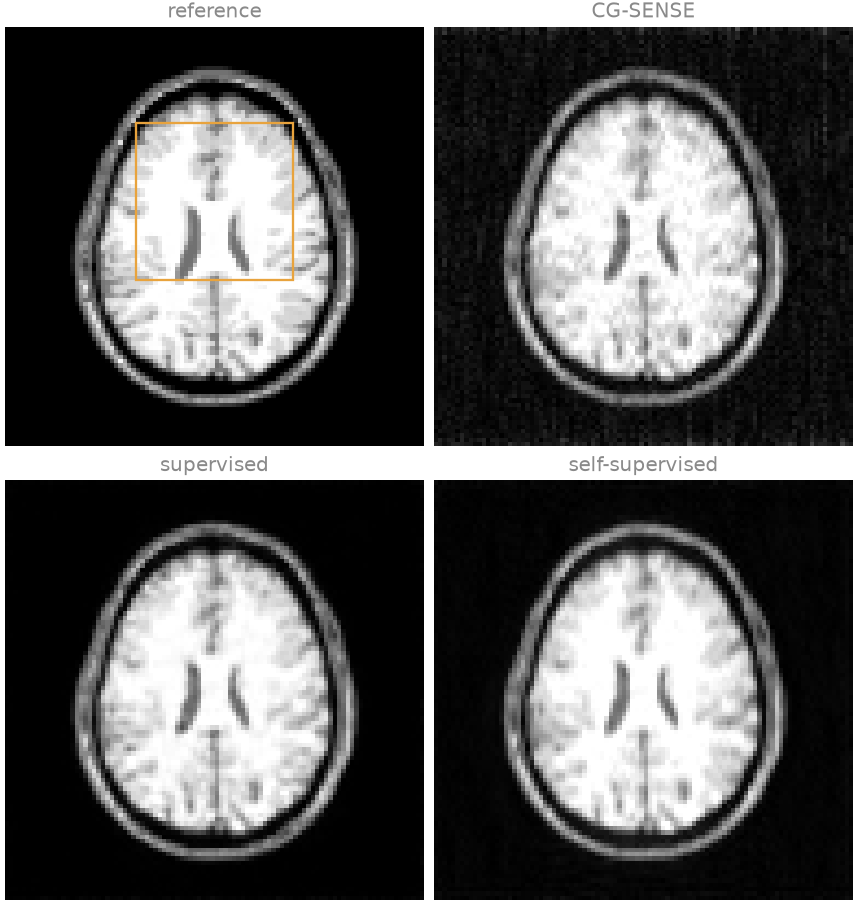 reference, CG-SENSE, supervised, self-supervised