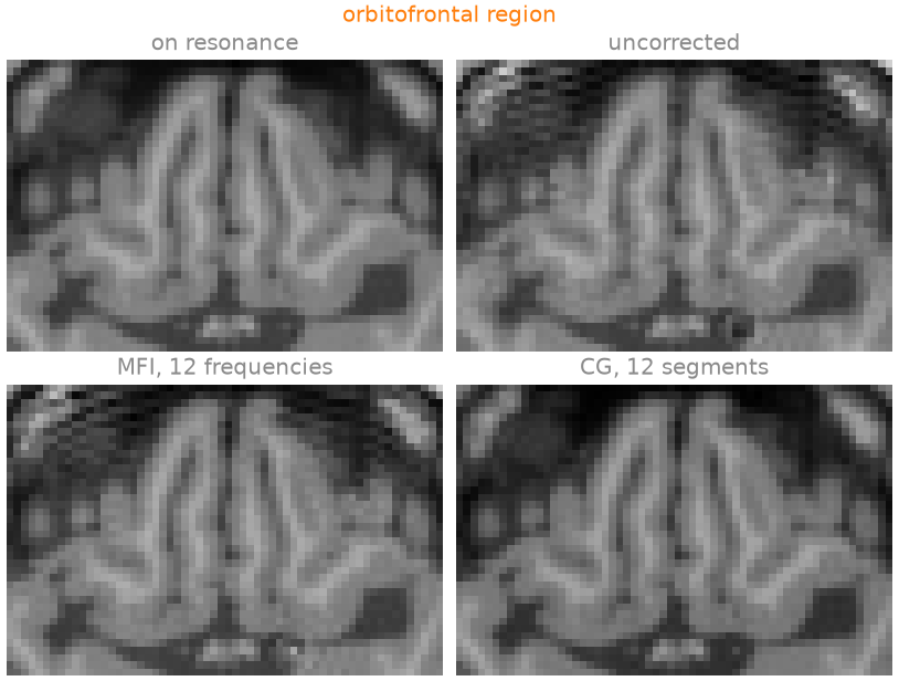 orbitofrontal region, on resonance, uncorrected, MFI, 12 frequencies, CG, 12 segments