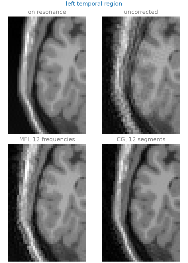 left temporal region, on resonance, uncorrected, MFI, 12 frequencies, CG, 12 segments