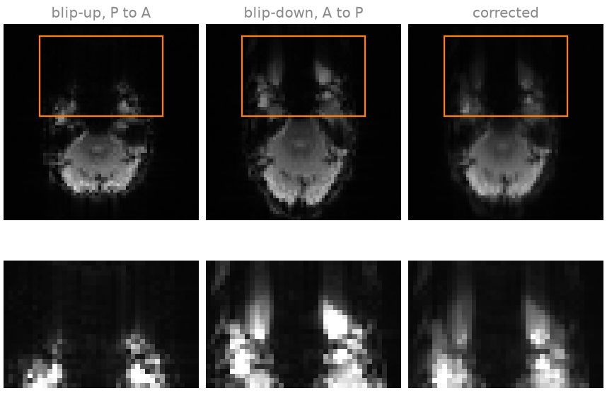 blip-up, P to A, blip-down, A to P, corrected